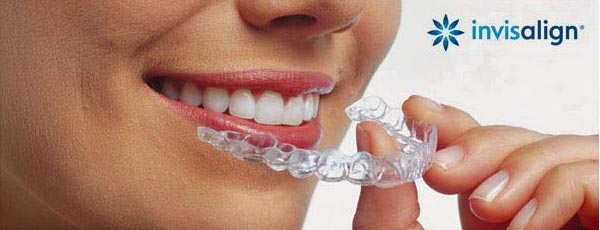 Clear Invisalign aligner held beside a smile